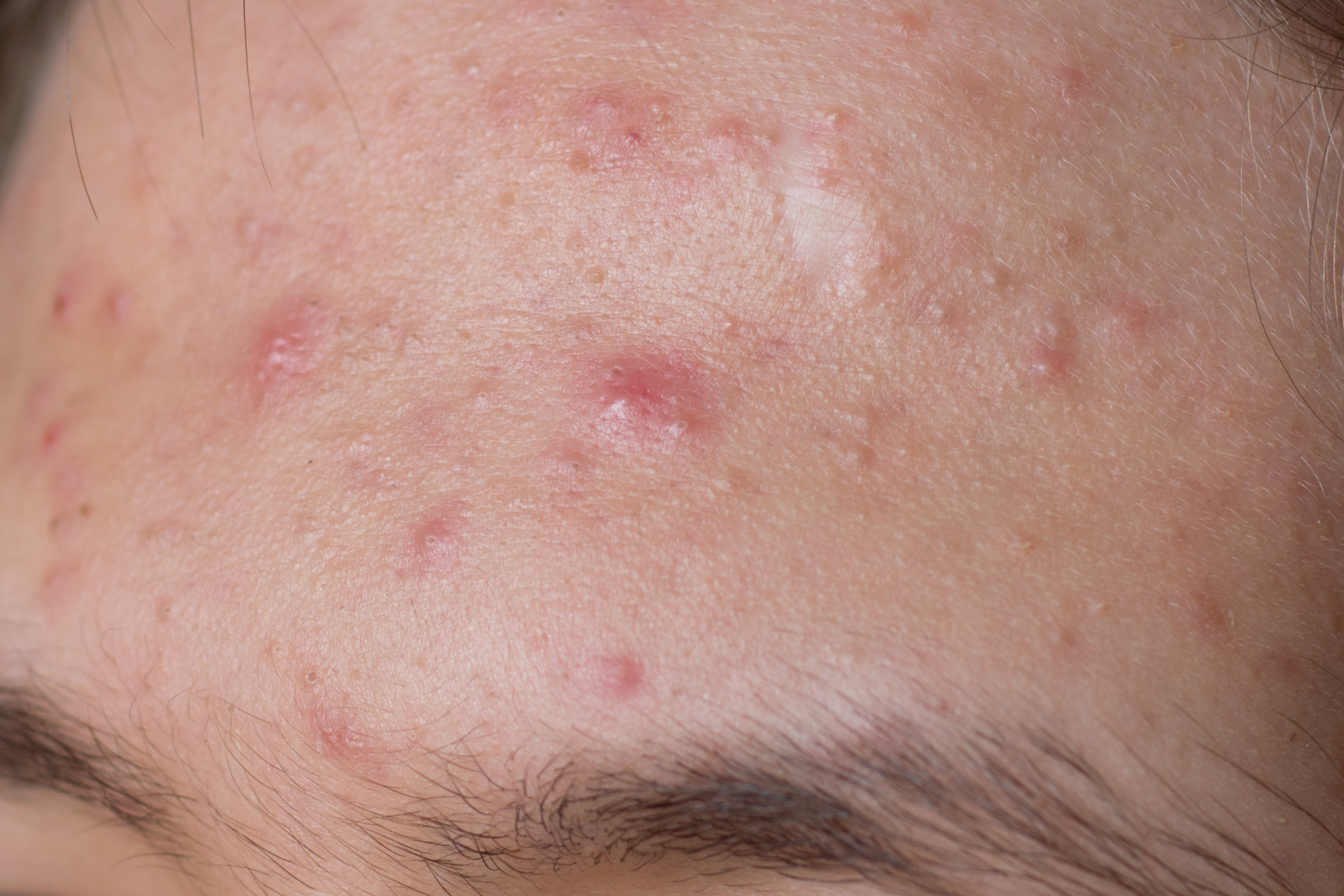 Akne hormoni: zakaj mozolji niso vedno le hormonski problem?