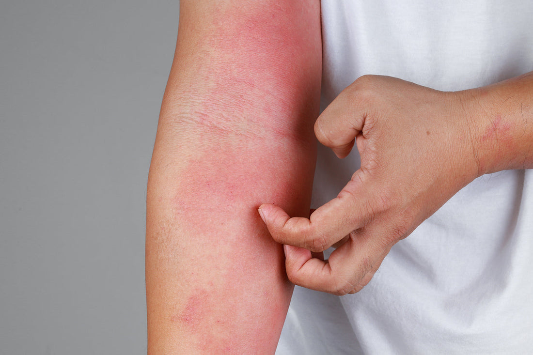 Atopijski dermatitis - simptomi in zdravljenje