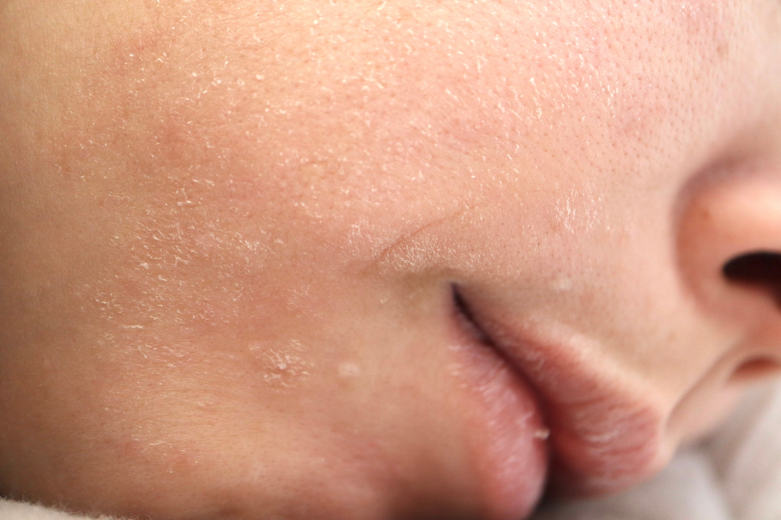 Suha koža na obrazu: vzroki, rešitve in nasveti za nego